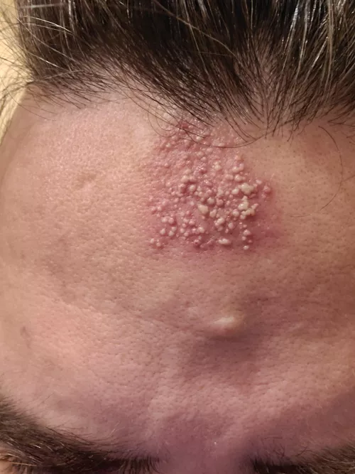 i want to squeegee with credit card along his forehead and watch them all blow