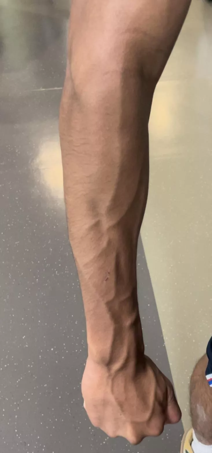 My vascular forearm can’t wait for a pump