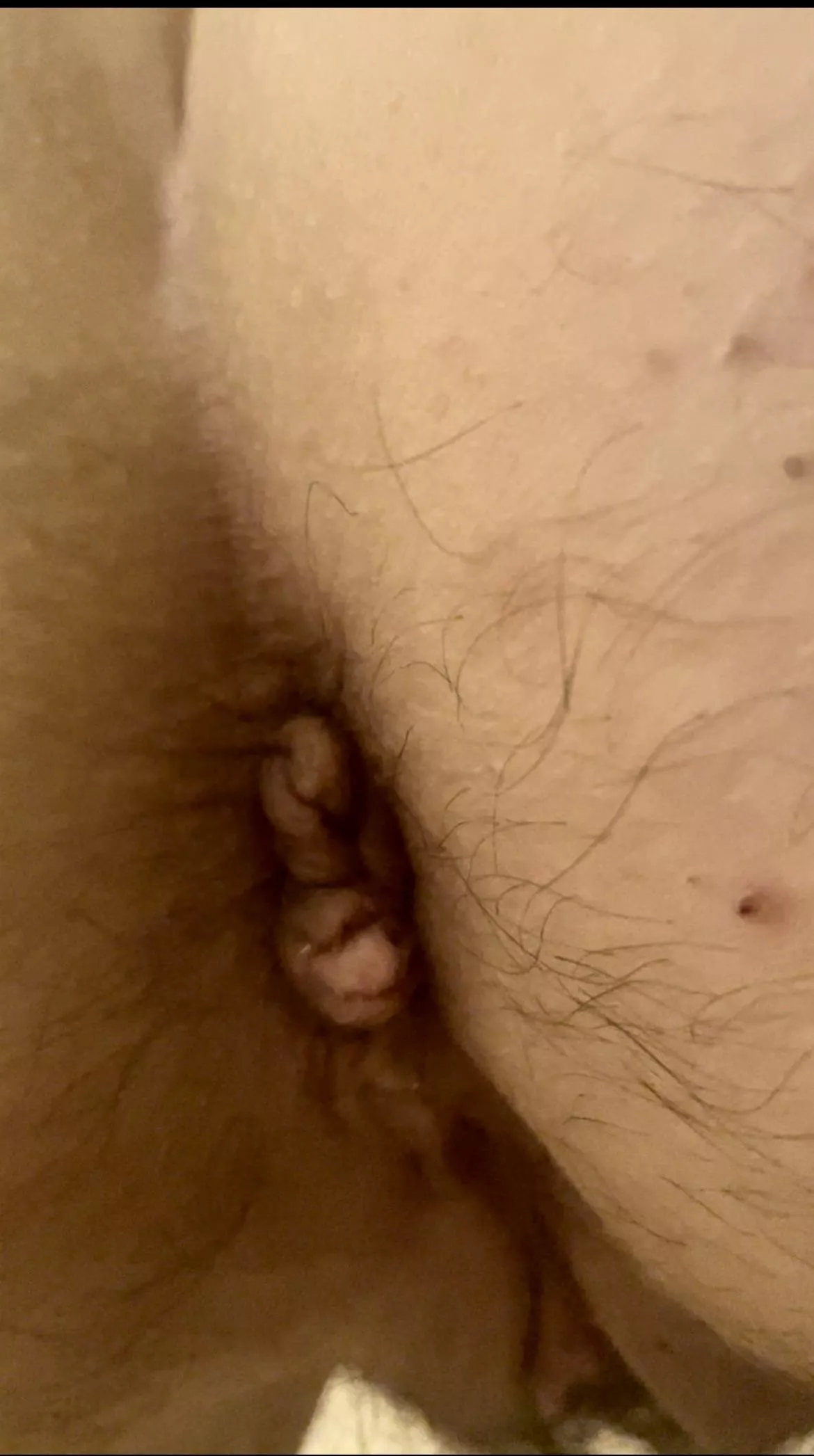 Close up of hairy ruined asshole